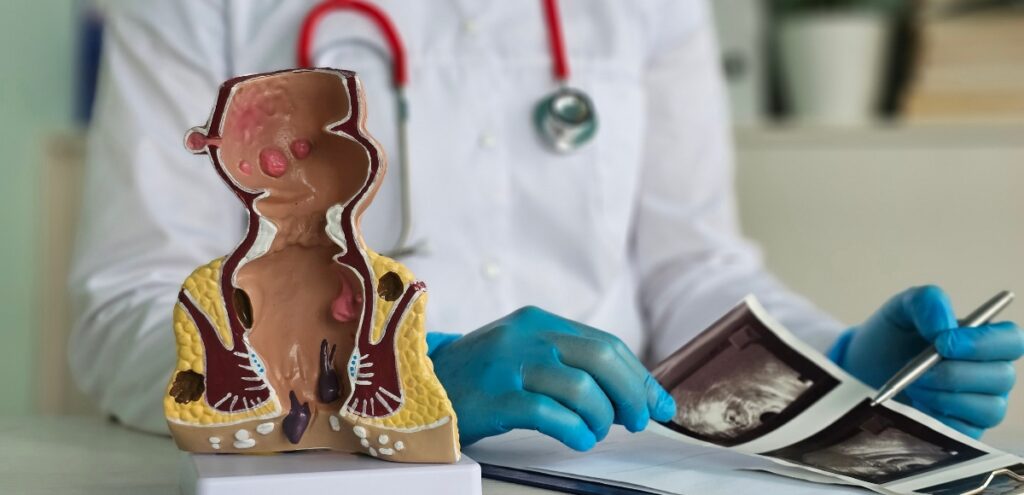 diverticolosi