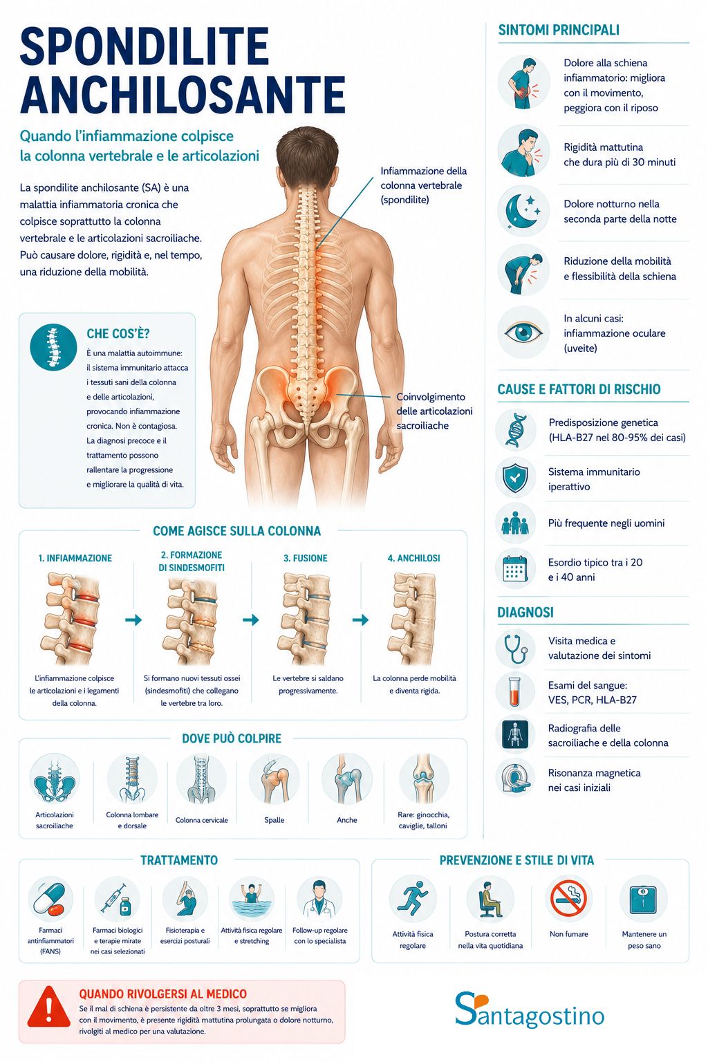 infografica spondilite anchilosante